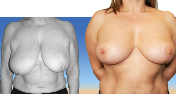 Réduction mammaire avant / après<